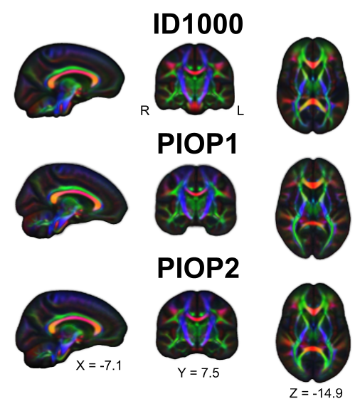 Diffusion-encoded color images of the FA-modulated median DTI eigenvectors across subjects. Red colors denote preferential diffusion along the sagittal axis (left-right), green colors denote preferential diffusion along the coronal axis (anterior-posterior), and blue colors denote preferential diffusion along the axial axis (inferior-superior). Brighter colors denote stronger preferential diffusion.