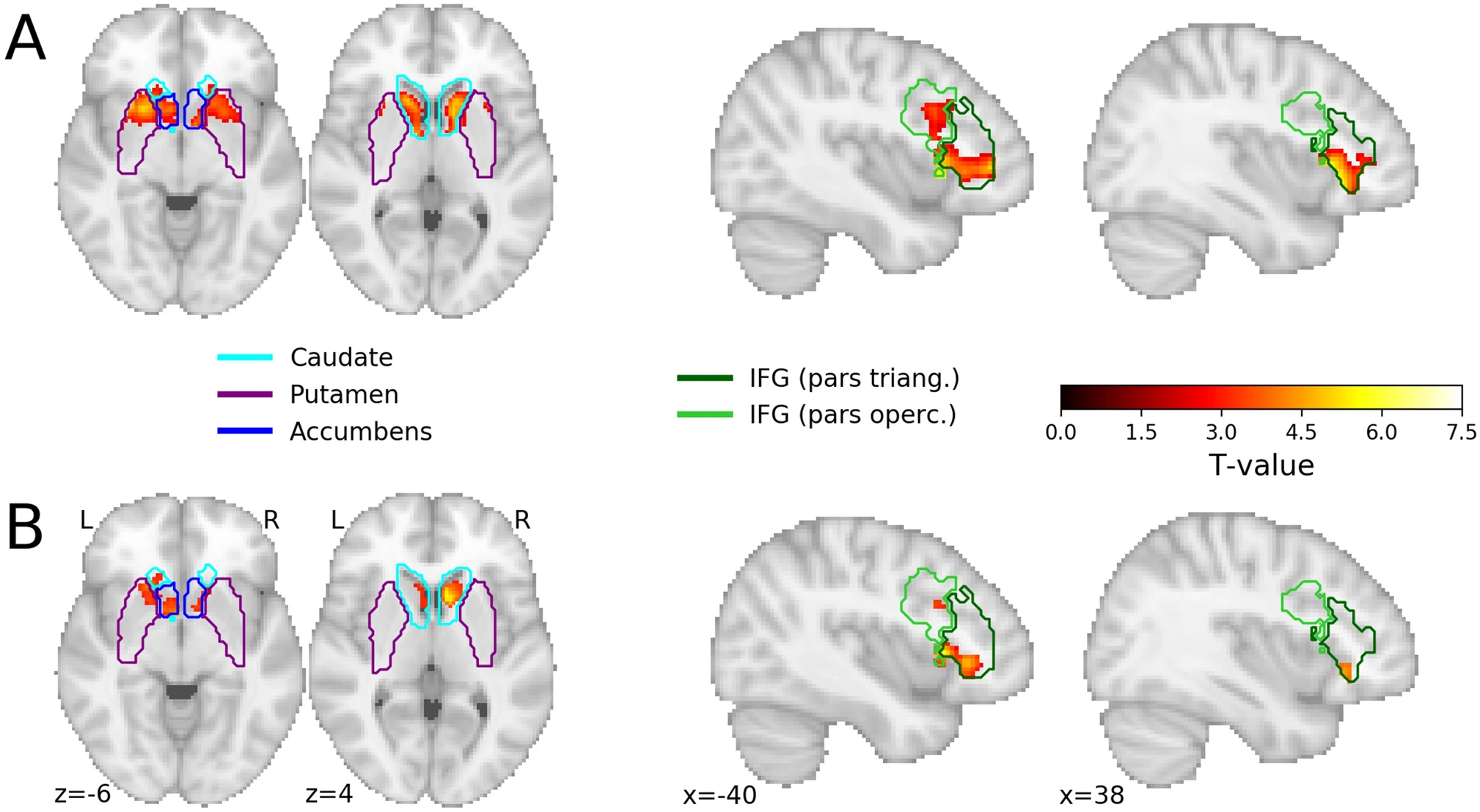 Results of confirmatory ROI analyses for the induction phase (A) the contrast negativeactive>passive (B) the contrast negativeactive>passive > positiveactive>passive. Voxels in red/yellow represent significant t-values (p < 0.05, corrected for multiple comparisons using the maximum statistic approach). The colored outlines represent the different brain regions within the probabilistic ROIs for the striatum (left) and inferior frontal gyrus (IFG; right). The outlines represent the border of the ROIs thresholded at 0. When voxels within one ROI had a nonzero probability in more than one brain region (e.g., the caudate and nucleus accumbens), the voxel was assigned to the brain region with the largest probability.