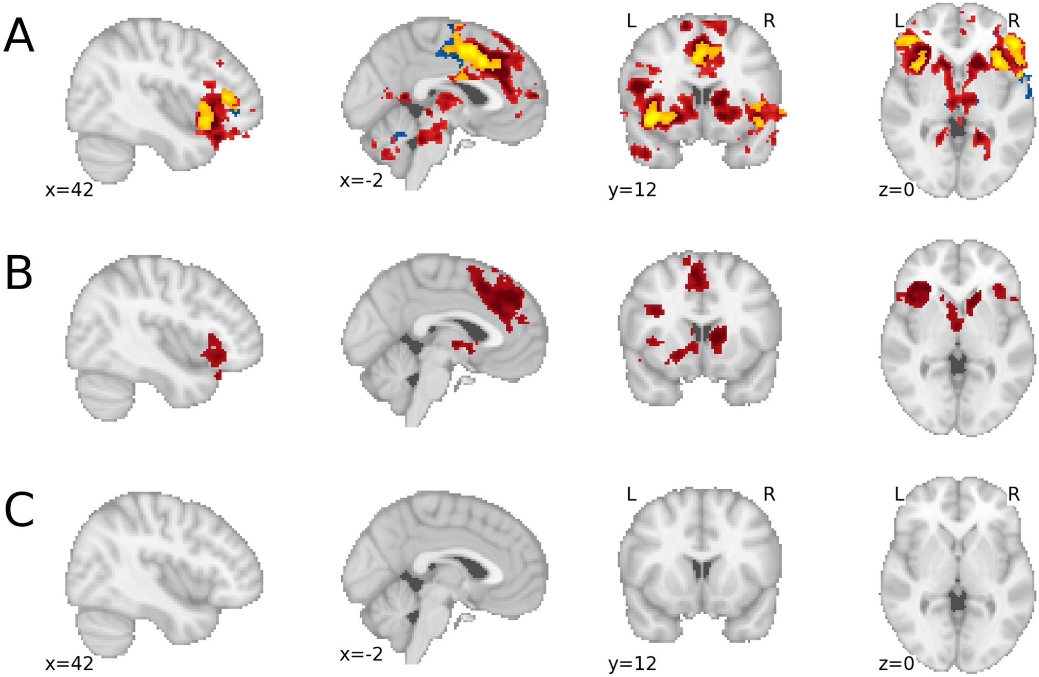 Results of the exploratory whole-brain analyses for the induction phase: (A) the contrast negativeactive>passive (red), positiveactive>passive (blue), and their conjunction (yellow); (B) the contrast negativeactive>passive > positiveactive>passive; (C) the contrast positiveactive>passive > negativeactive>passive (empty).